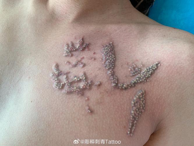 医院洗纹身挂什么科