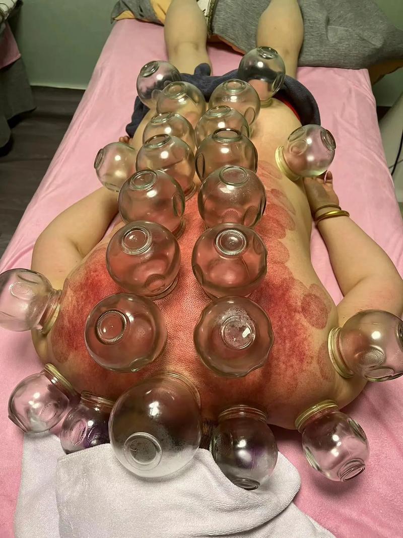 拔火罐减肥早晨吃什么