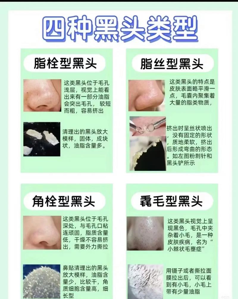 为什么会长黑头粉刺