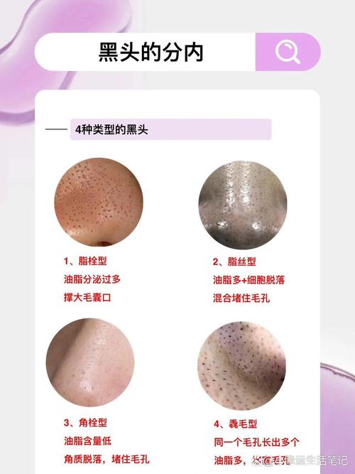 为什么会长黑头粉刺