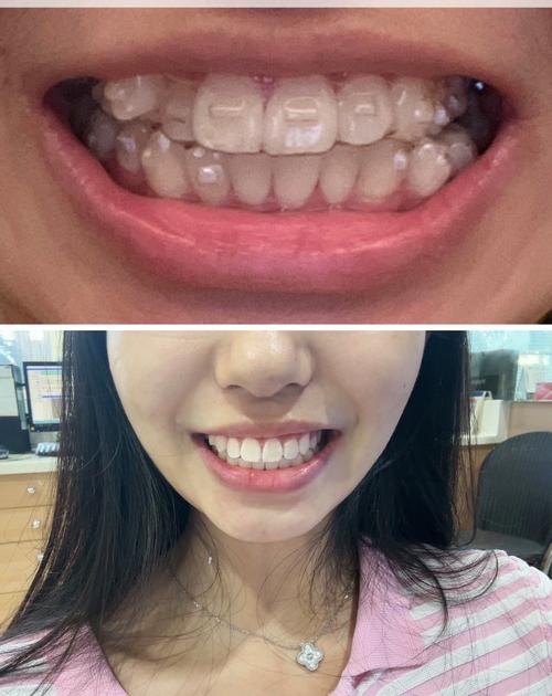 隐形矫正是什么