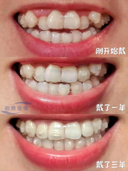 隐形矫正是什么