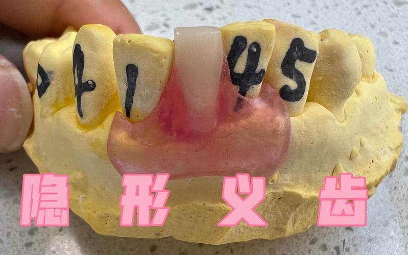 隐形义齿是什么