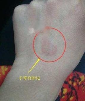 背上有胎记代表什么