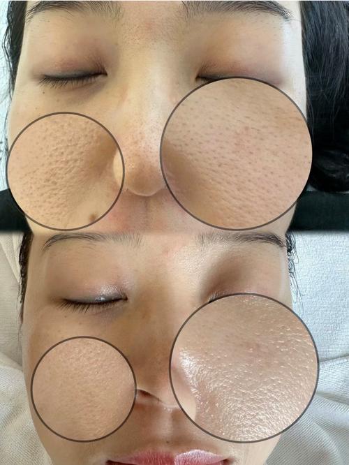 什么收缩毛孔效果好