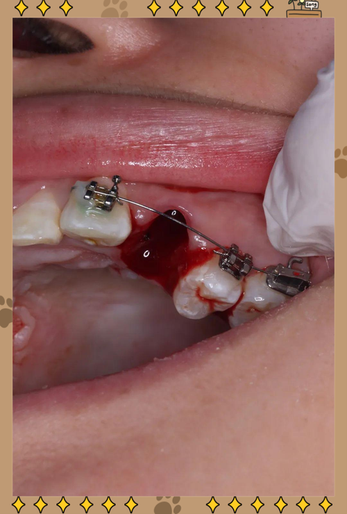 正畸为什么要拔牙