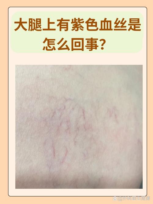 为什么会出现红血丝