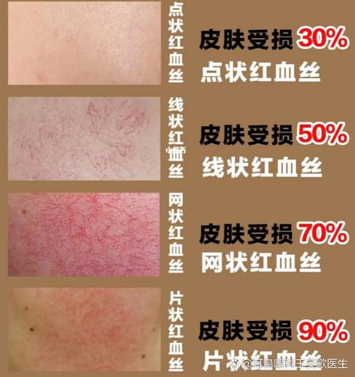 为什么会出现红血丝