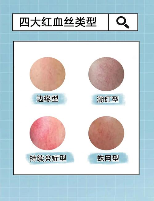 为什么会出现红血丝