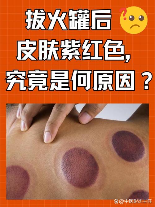 拔罐减肥为什么一点颜色都没有