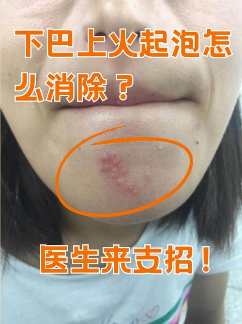 下巴发红是什么原因