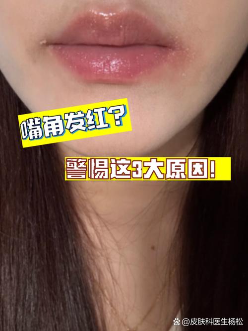 下巴发红是什么原因