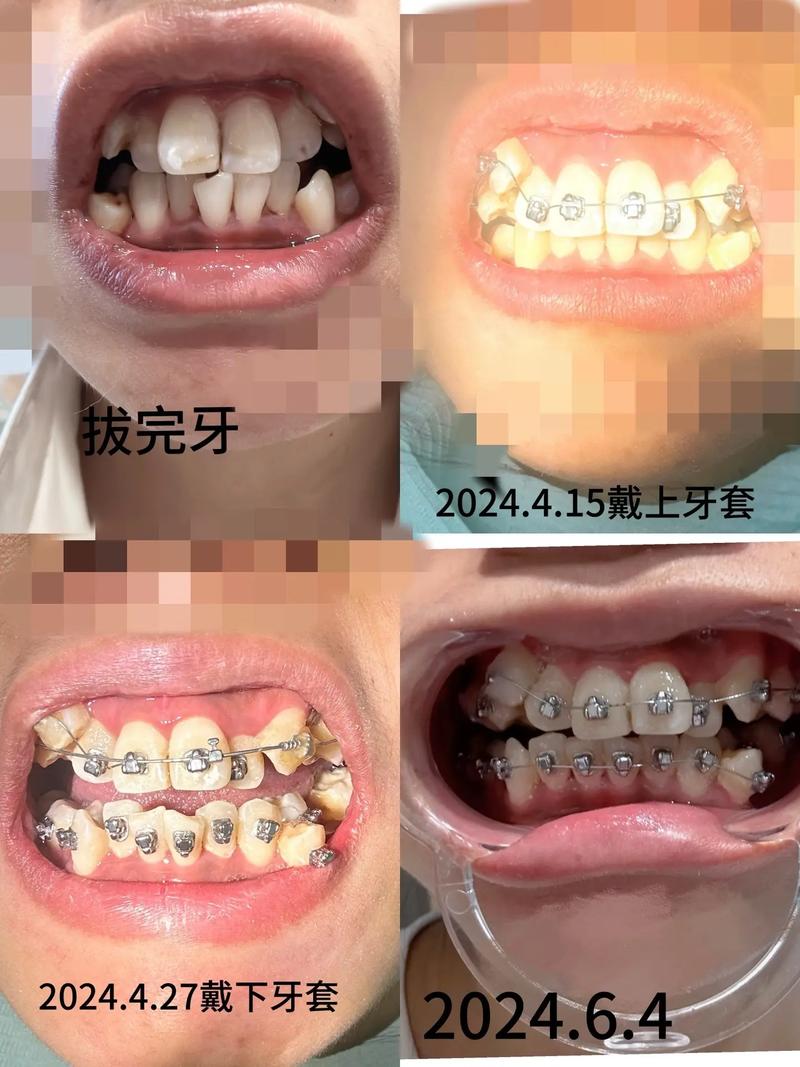 戴牙套有什么坏处