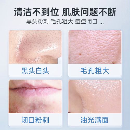 闭口粉刺用什么面膜