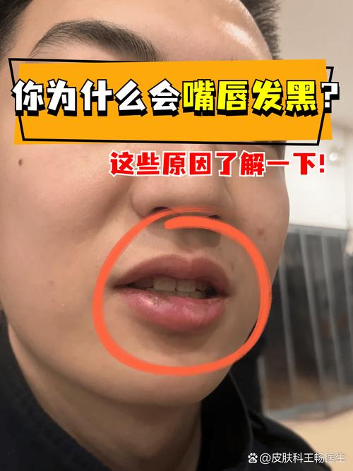 为什么嘴唇颜色深