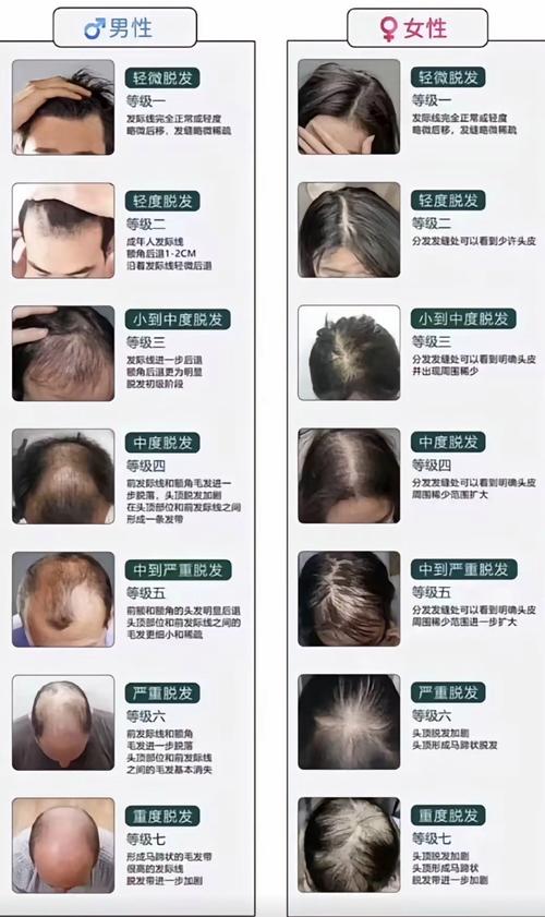 掉头发是什么原因引起