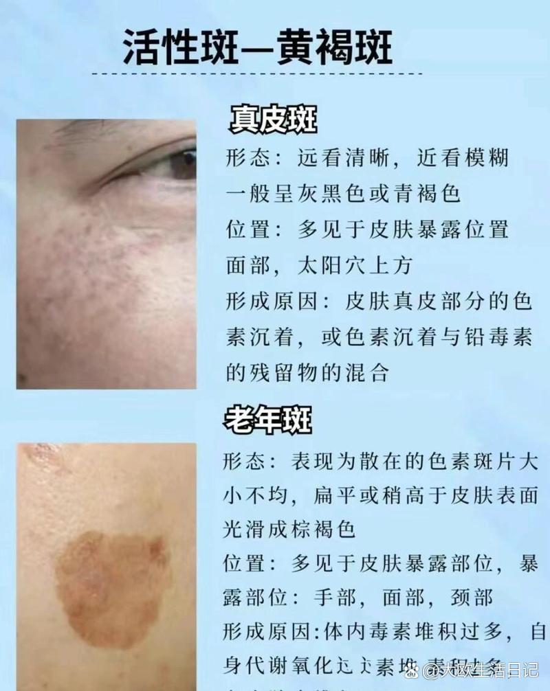 皮肤黑斑是什么原因