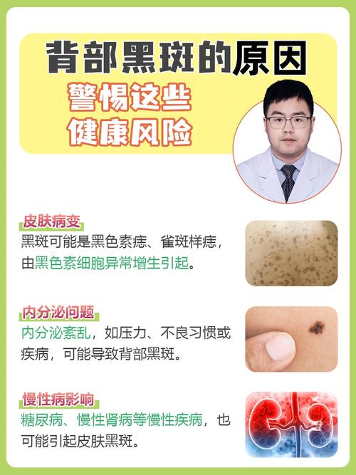 皮肤黑斑是什么原因