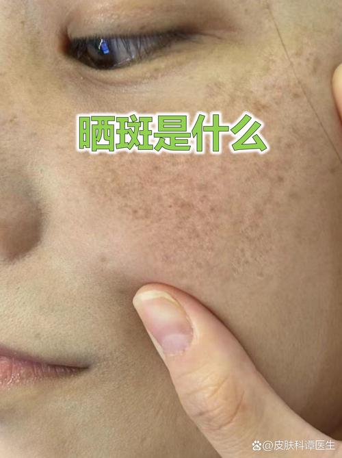 晒斑是什么样的