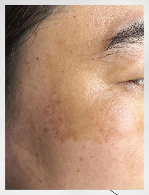 晒斑是什么样的