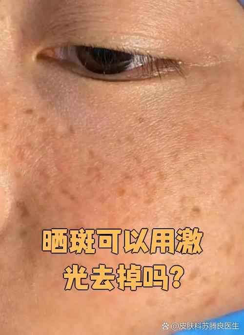 晒斑是什么样的