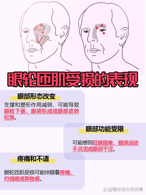 眼轮匝肌是什么