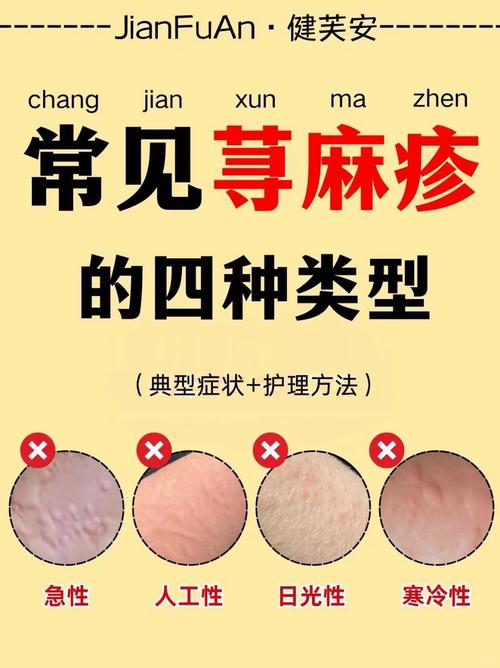 荨麻疹应注意什么