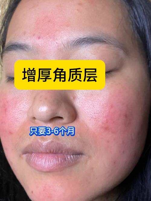 脸上的角质是什么