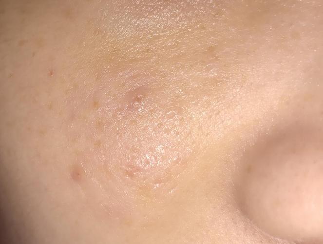 脸上的角质是什么