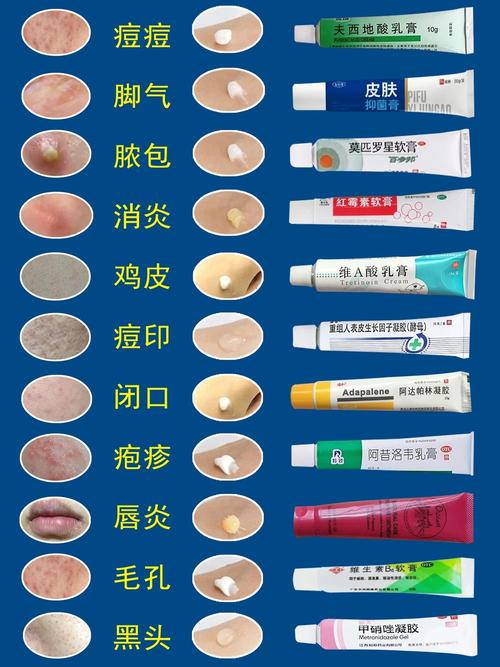 脸上痤疮用什么药膏