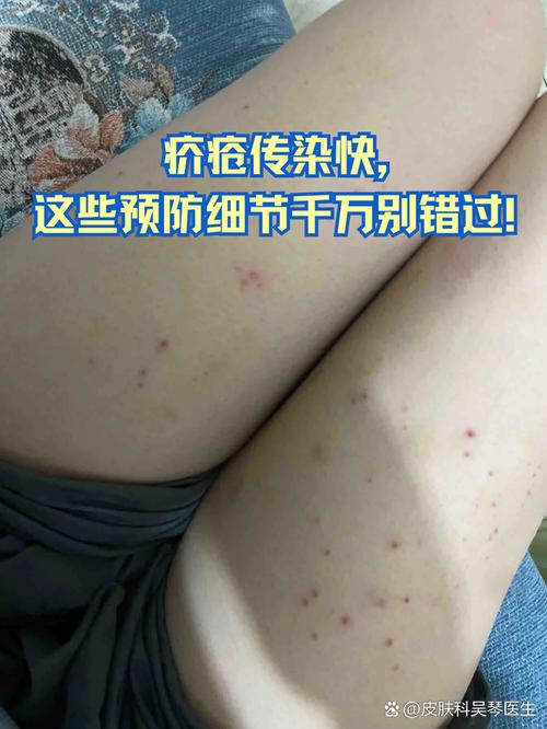 疥疮要注意什么