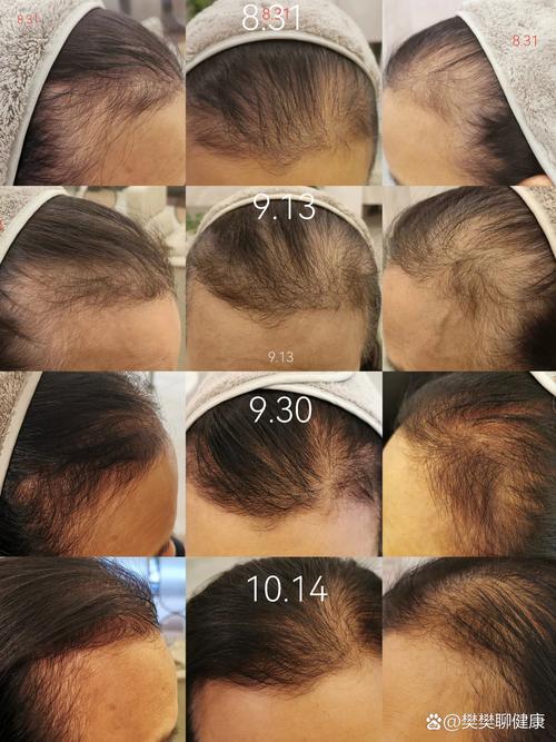 头发毛囊什么样