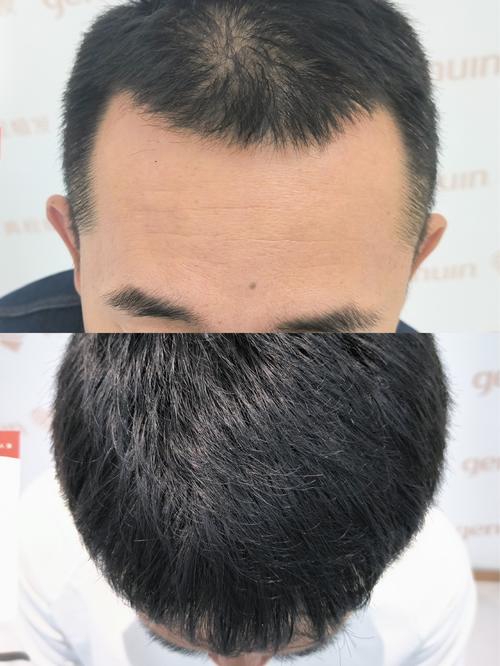 发际线为什么会高