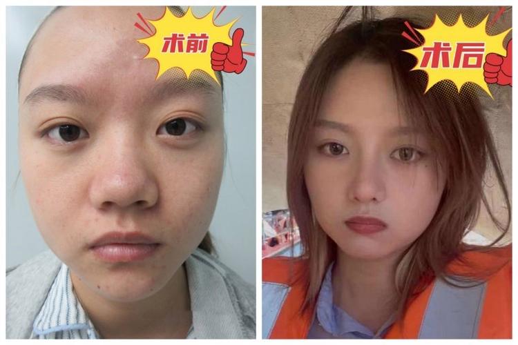 鼻梁为什么会塌