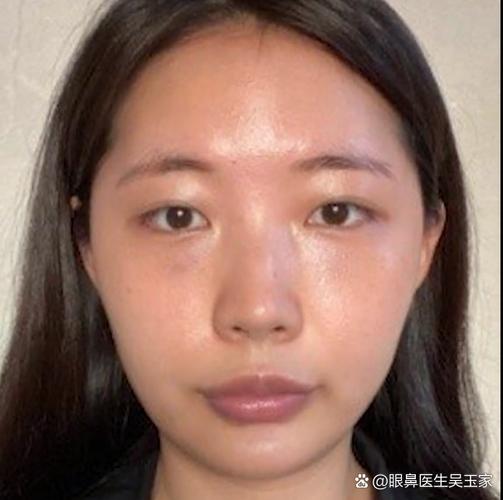 鼻梁为什么会塌