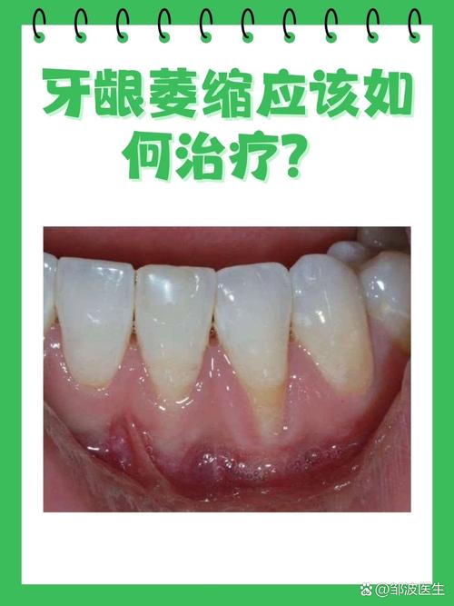 牙龈萎缩缺什么