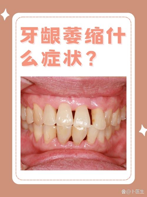 牙龈萎缩缺什么