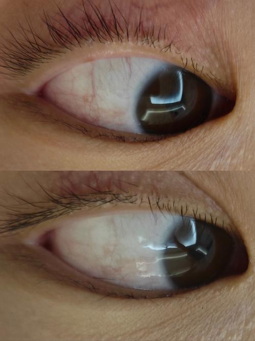 为什么眼睛里有血丝