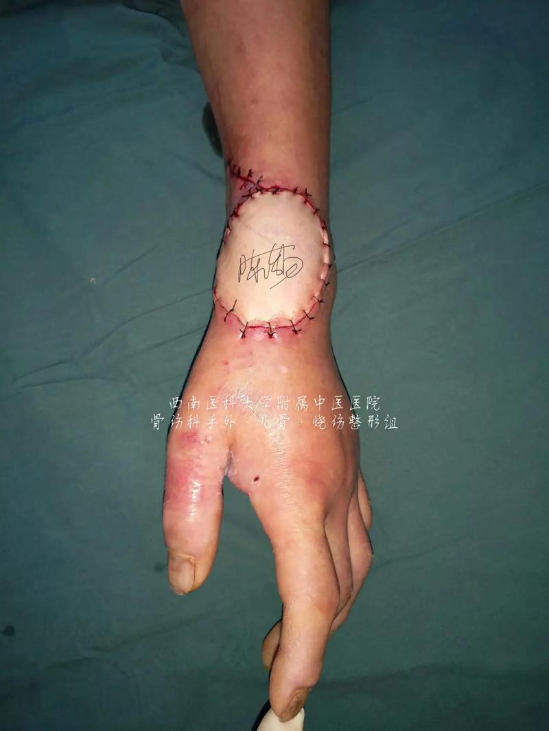 什么是皮瓣手术