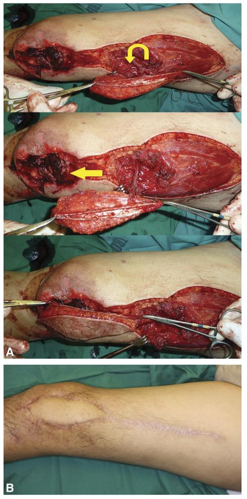 什么是皮瓣手术