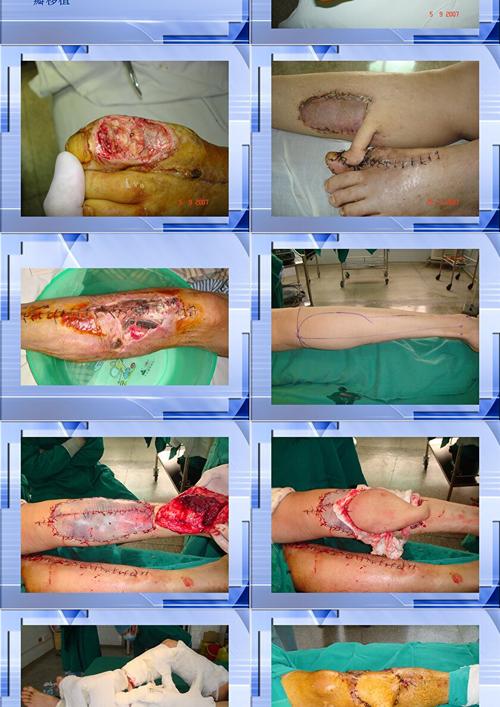 什么是皮瓣手术