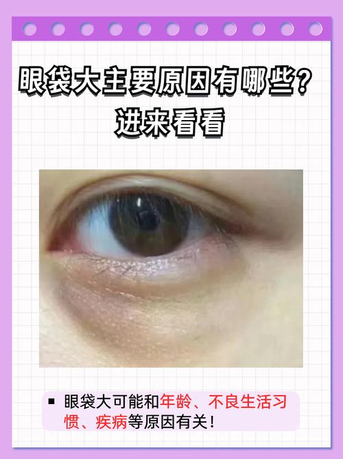 眼袋大是什么病
