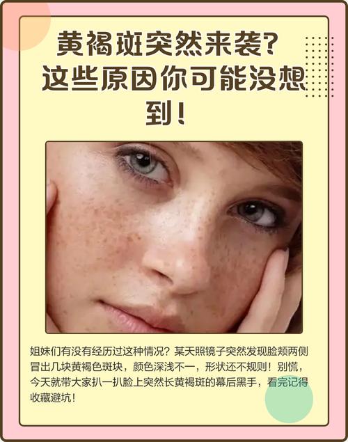 女人长斑是什么原因