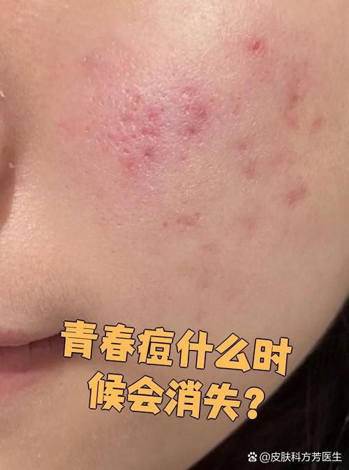 青春痘是什么意思