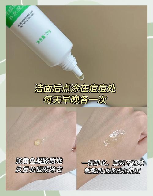 长痘应该吃什么药