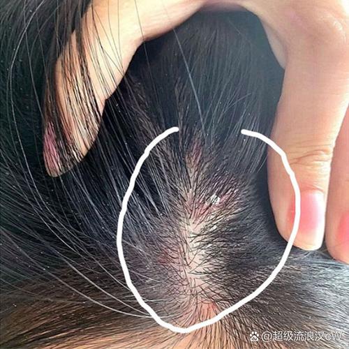 头皮紧是什么原因