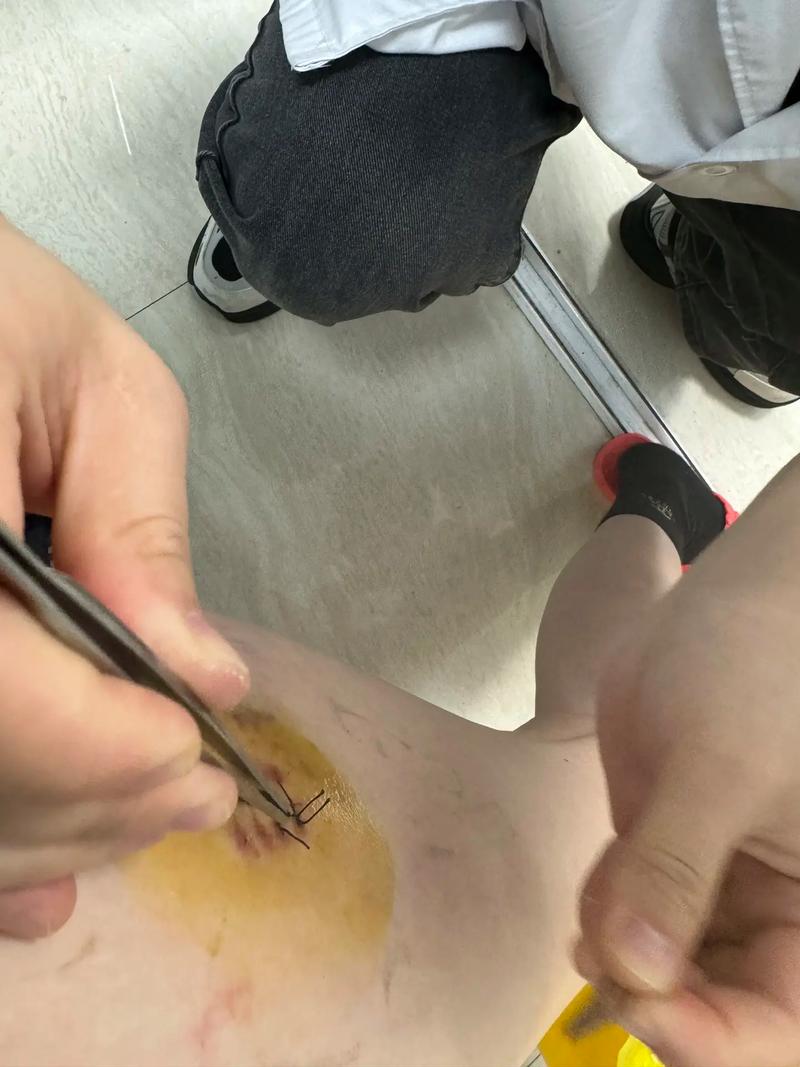 拆线为什么不疼