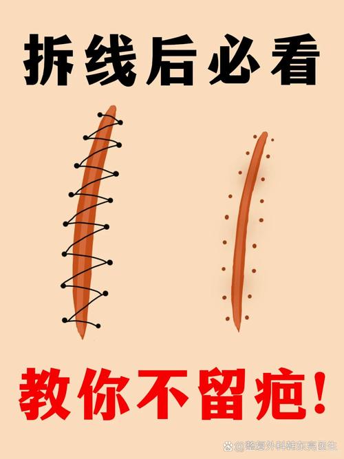 拆线为什么不疼