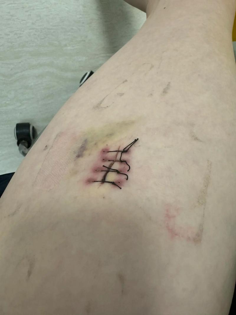 拆线为什么不疼