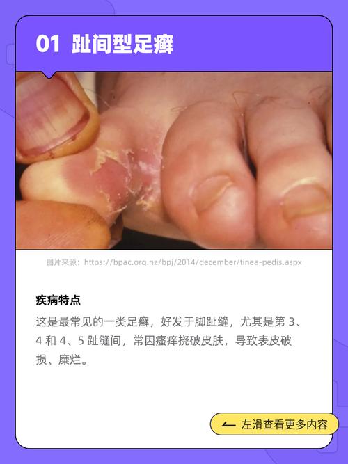 什么治脚气效果最好